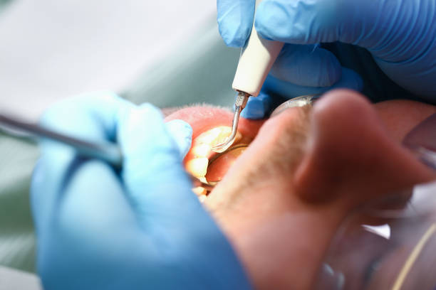 Best Emergency Dental Care for Broken or Chipped Teeth in Huntingtown, MD